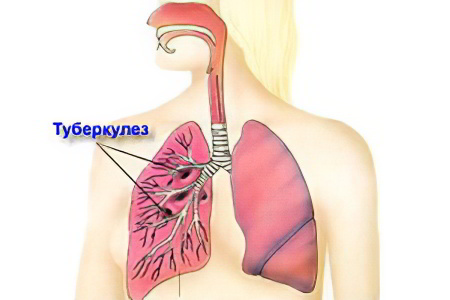 Туберкулез