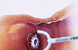 Можно ли забеременеть после прижигания эрозии шейки матки?
