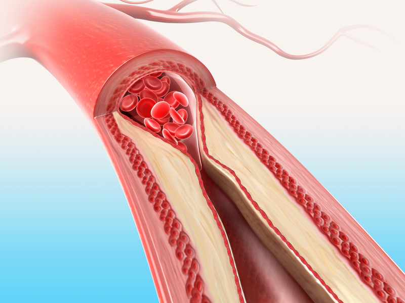 Облитерирующий атеросклероз что это