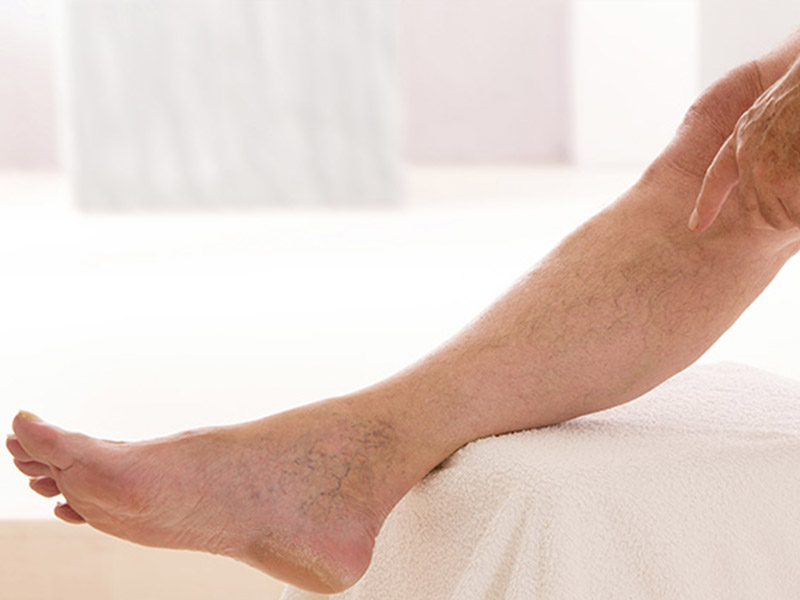 Облитерирующий атеросклероз виды