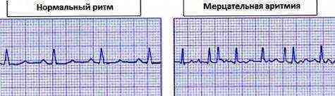 осложнения после акш