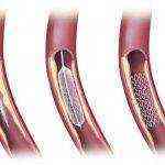 осложнения после акш