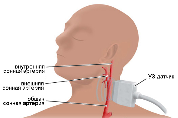 дуплексное сканирование сосудов головы и шеи