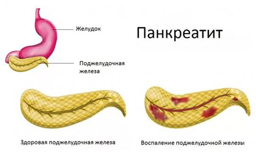 Панкреатит лечение