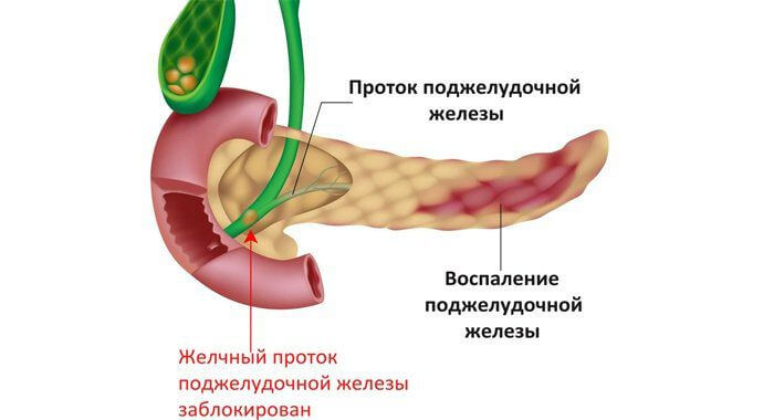 Kak-vyglyadit-vospalennaya-podzheludochnaya