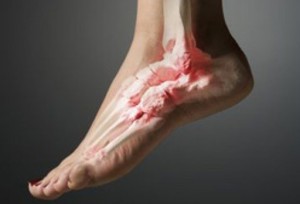 Как лечат артроз голеностопного сустава