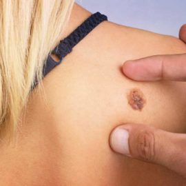 Родинка или меланома
