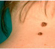 Может ли бородавка пройти сама и исчезнуть