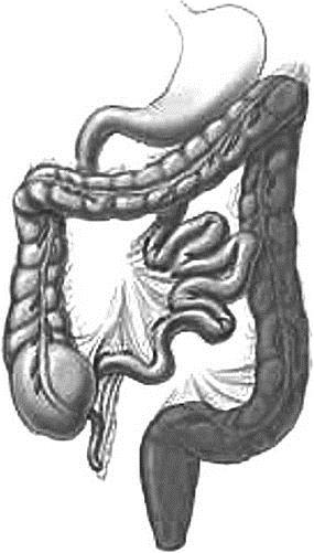 Неспецифический язвенный колит