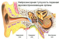 Схема нейросенсорной тугоухости