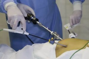 Температура после удаления желчного пузыря