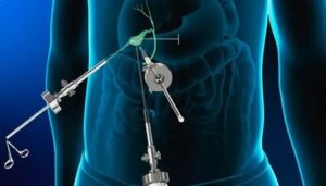 Температура после удаления желчного пузыря