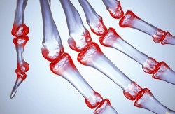 ревматоидный артрит