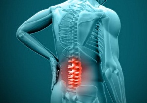 радикулит симптомы и лечение дома