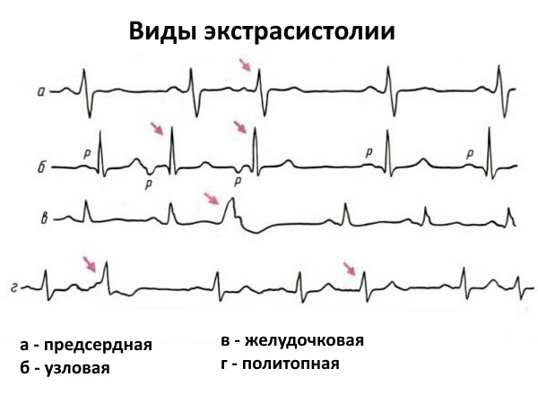 Виды экстрасистолии