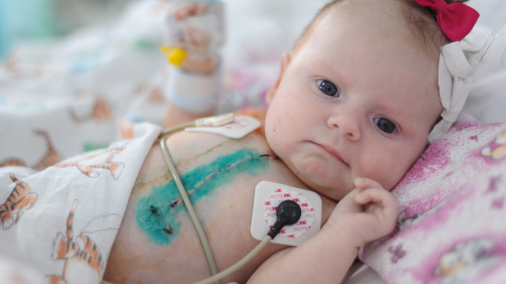 Малыш, который перенес хирургическое вмешательство