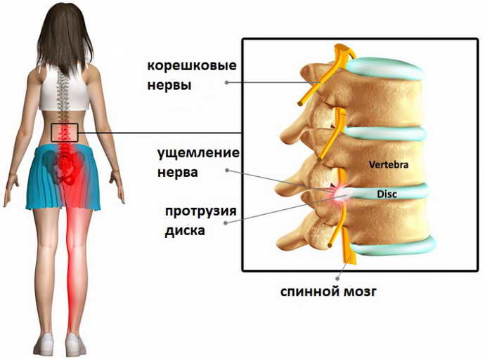 может ли быть температура при остеохондрозе признаки