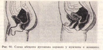 Аппендэктомия осложнения МЦПК Русаков В.И.
