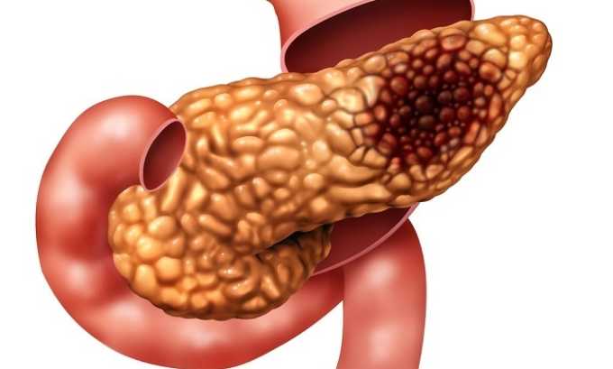 Не всегда при панкреатите возникает лихорадка. Понижение температуры возможно при переходе недуга в острую форму