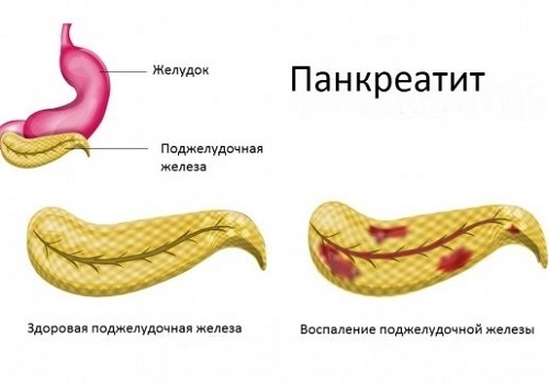 Панкреатит